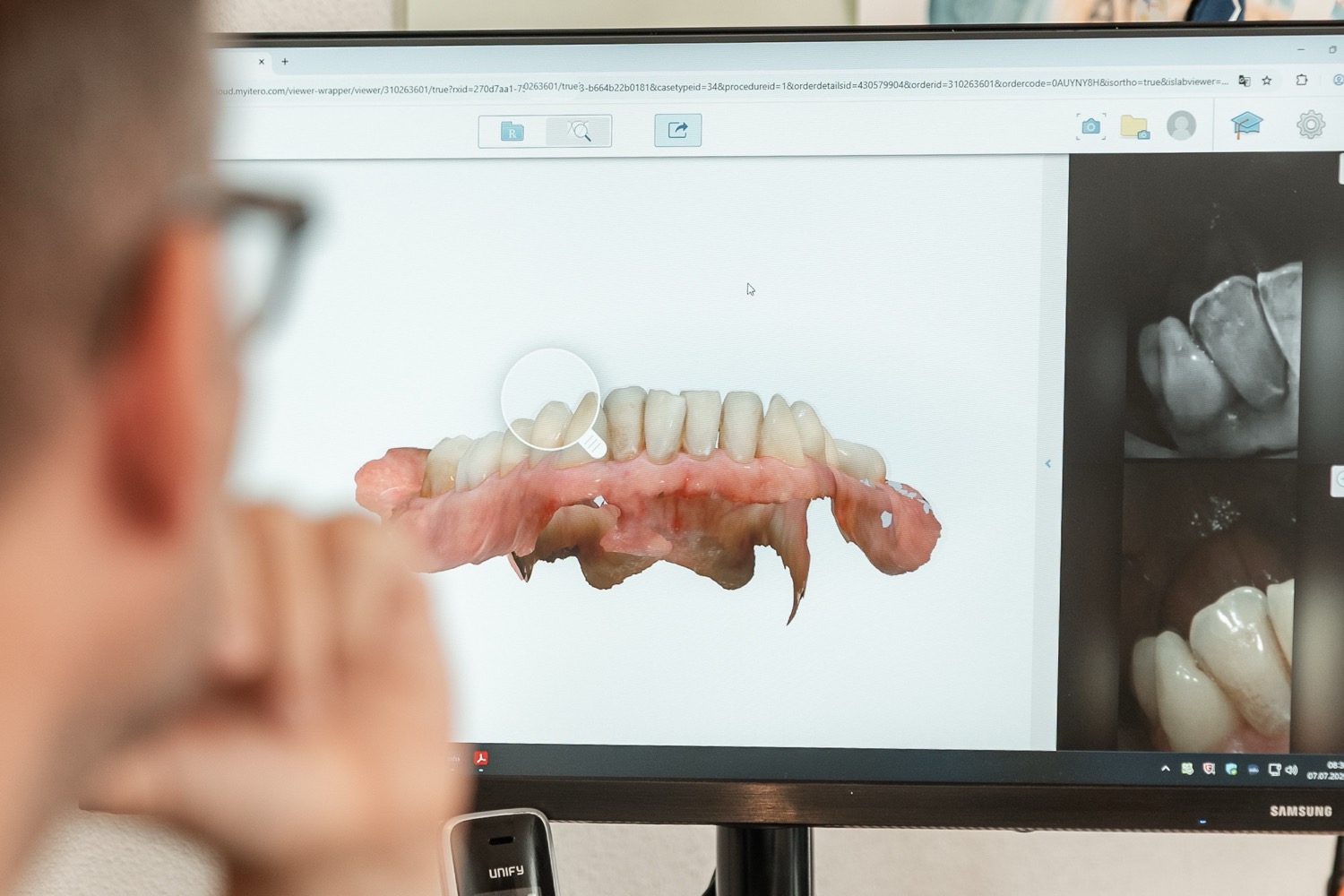 Digitaler 3D-Scan eines Zahns am Bildschirm